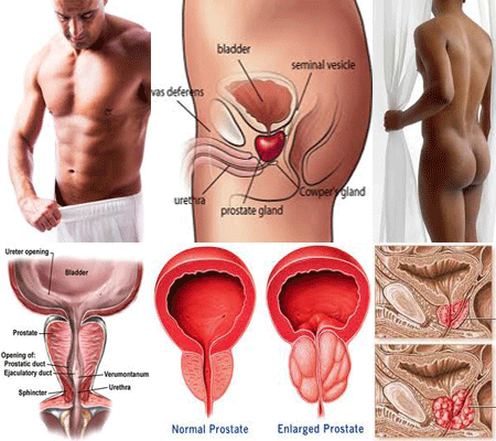 Longidáz gyertyák a Prostatitis Véleményektől Ciprolets a prostatitis alatt